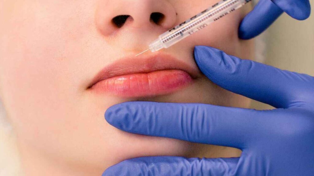 A lip filler treatment being administered to a woman's lips with a syringe by a professional wearing blue gloves.