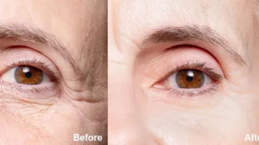 Before and after comparison of under-eye wrinkle treatment, showing visible improvement in skin smoothness and reduced wrinkles.