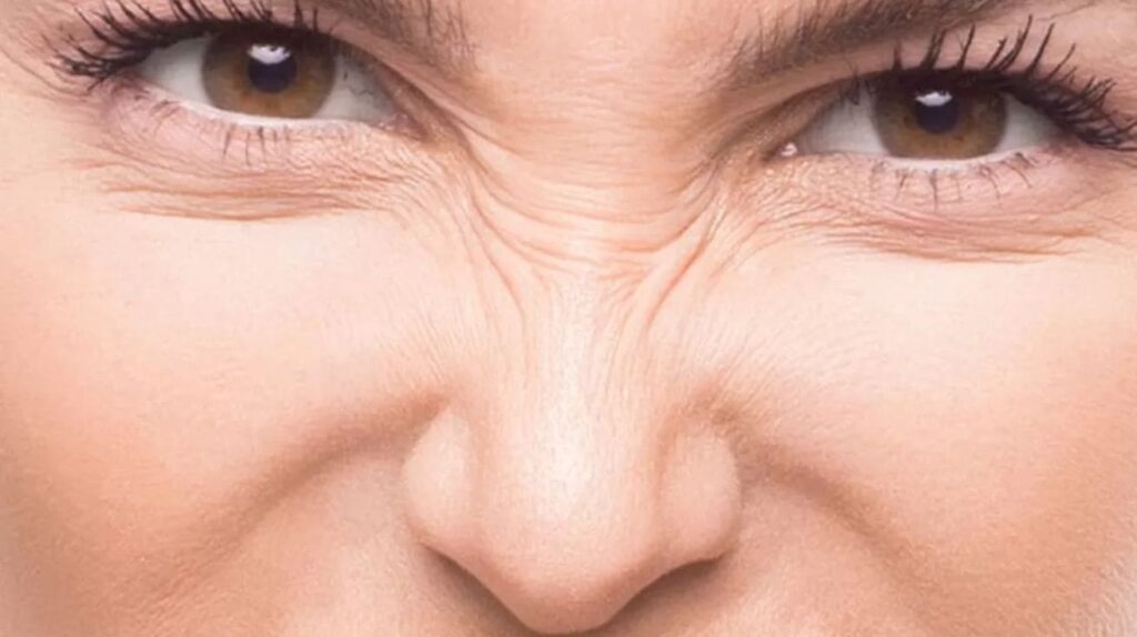 Close-up of a woman showing bunny lines on her nose when making a facial expression.