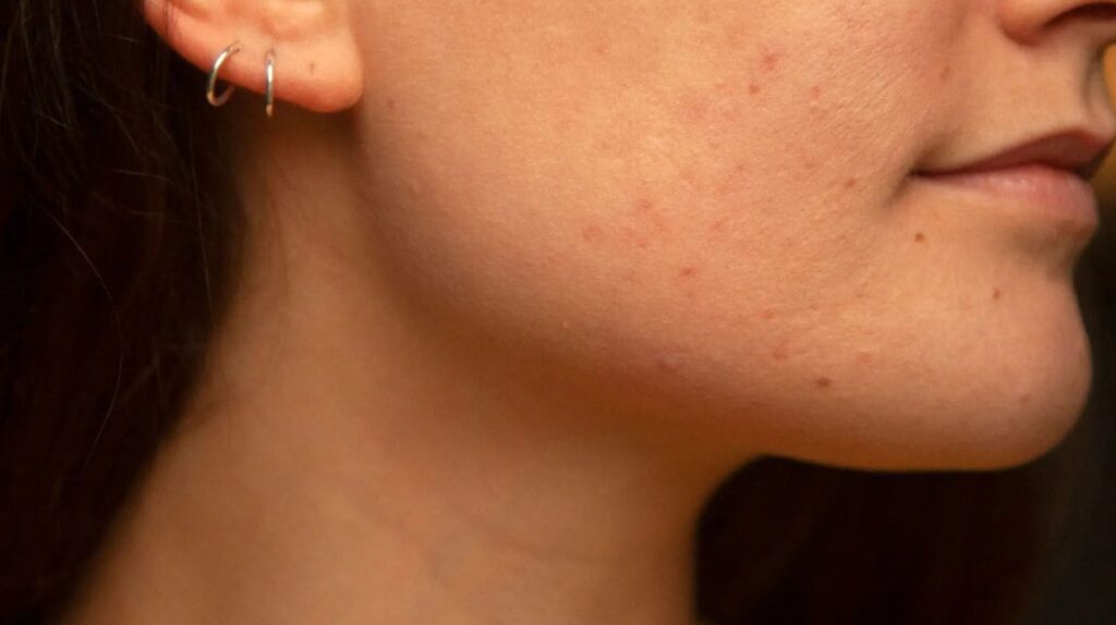 A female  jawline with visible acne and blemishes along the skin, showing small pimples near the lower cheek and chin area.