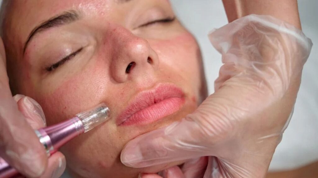 A close-up view of a microneedling treatment being performed on a woman's face, with a professional wearing gloves using a microneedling device on her skin near the lip area.