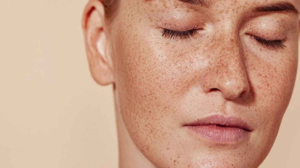 Close-up of freckled skin showing natural pigmentation and dark spots on a woman’s face.