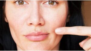 How to Get Rid of a Lip Pimple