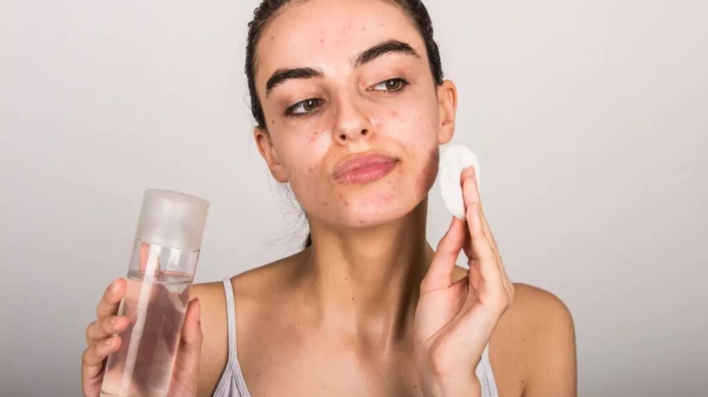 A woman using a cotton pad and skincare product to clean her face, showing signs of acne and skincare routine.